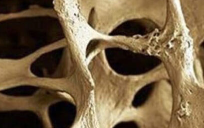 POSTICIPATO – Osteoporosi: Update, tip and tricks